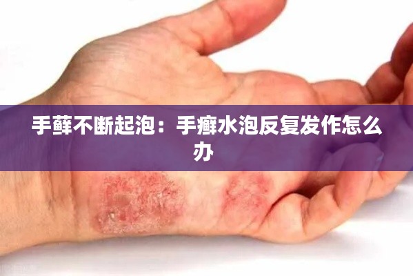 手藓不断起泡:手癣水泡反复发作怎么办