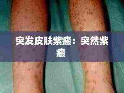 突发皮肤紫癜:突然紫癜