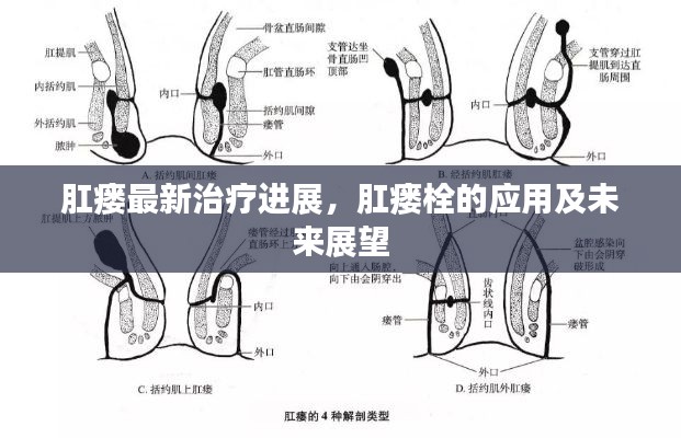 肛瘘最新治疗进展,肛瘘栓的应用及未来展望